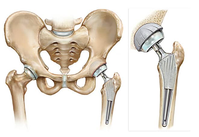 artificial bones