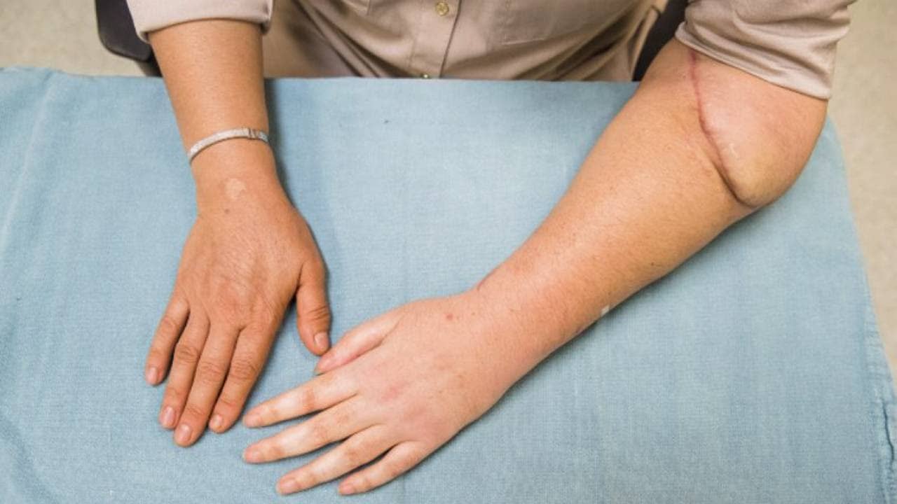 artificial hand in india