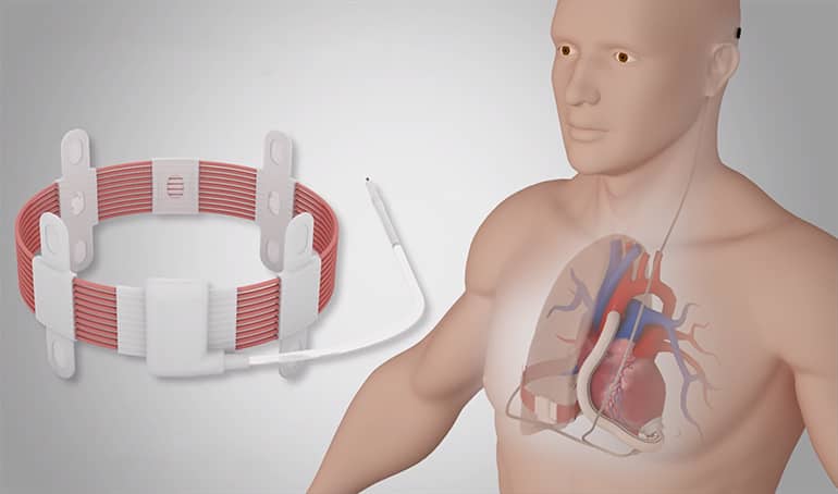 artificial heart valve